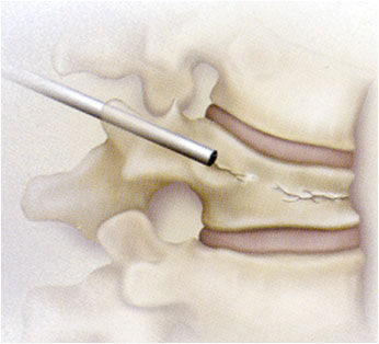 Vertebroplastia
