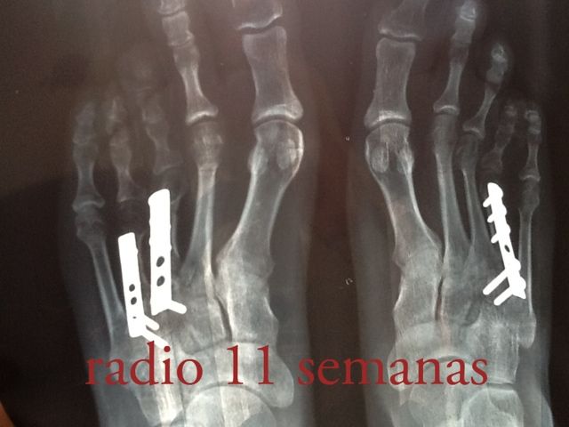 Braquimetatarsia (Después)
