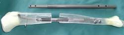 ISKD (Elongación osea de Tibia-Pierna)